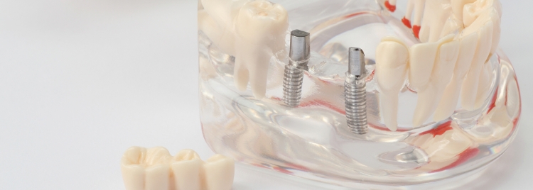 安全なインプラント